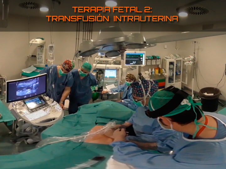 Terapia fetal 2: Transfusión intrauterina